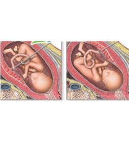 胎盤低置 胎盤低置