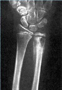 骨幹結核 骨幹結核