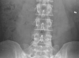 胸椎腰化 胸椎腰化