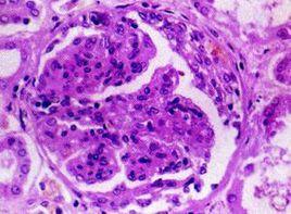 血清抗GBM抗體陽性 血清抗GBM抗體陽性