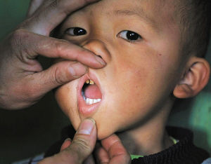 氟污染使兒童蛀牙