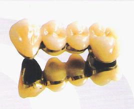 鍍金烤瓷牙 鍍金烤瓷牙