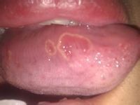 舌頭潰瘍 舌頭潰瘍