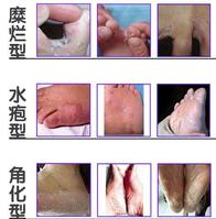 各種腳臭腳氣症狀