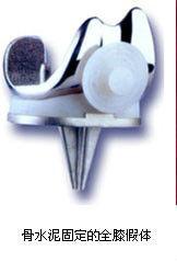 人工膝關節 人工膝關節