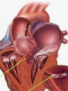 圍生期性心肌病 圍生期性心肌病