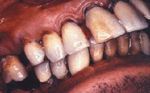 急性化膿性腮腺炎