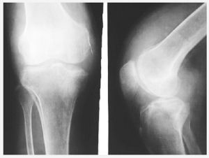 膝關節半月板損傷