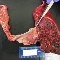 直腸尖銳濕疣 直腸尖銳濕疣