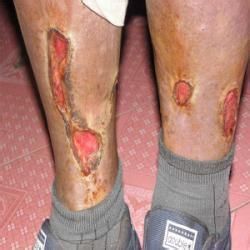 慢性皮膚潰瘍 慢性皮膚潰瘍