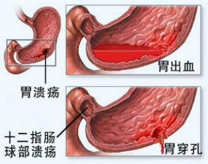 胃潰瘍圖片