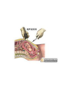 羊水穿刺 羊水穿刺