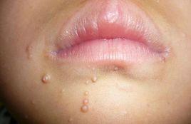 傳染性上皮瘤 傳染性上皮瘤