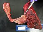患有膽管內乳頭狀腫瘤的內臟解剖圖