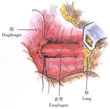 示意圖8:結紮裂孔前方的褥式縫線