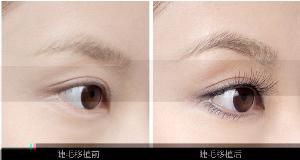 睫毛移植 睫毛移植