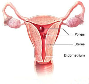 子宮息肉 子宮息肉