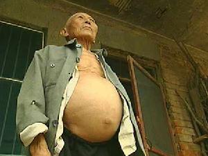 埃及血吸蟲病 埃及血吸蟲病