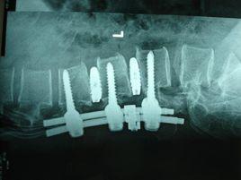 腰椎間盤突出微創術 腰椎間盤突出微創術