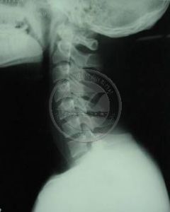 齒狀突發育畸形