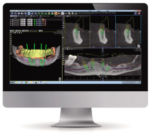 微數位化種植牙