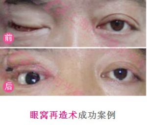 眼窩再造術成功案例