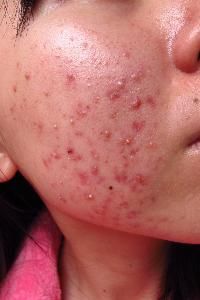 依賴性皮炎 依賴性皮炎