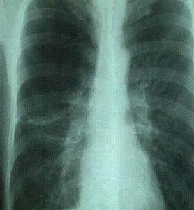 （圖）呼吸系統疾病