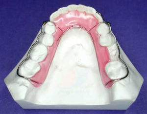 間隙保持器 間隙保持器