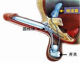 陰莖假體 陰莖假體