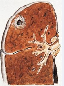 浸潤型肺結核