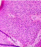 鮑溫樣丘疹病 鮑溫樣丘疹病