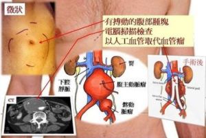 感染性腹主動脈瘤 感染性腹主動脈瘤