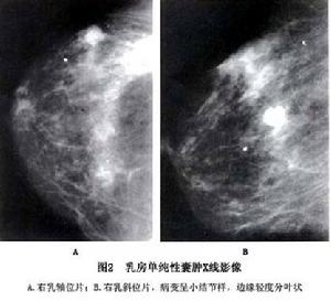 乳房單純囊腫 圖2