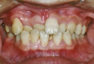 牙列不齊 牙列不齊