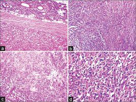 神經纖維肉瘤 神經纖維肉瘤