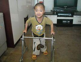 遲緩性腦癱 遲緩性腦癱