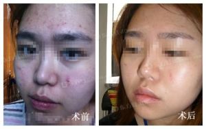 雷射去痘 雷射去痘