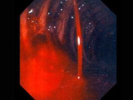 胃、十二指腸潰瘍合併出血 胃、十二指腸潰瘍合併出血