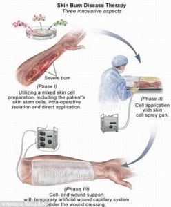 對燒傷皮膚患者提取健康的幹細胞