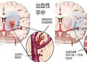 突發性腦溢血