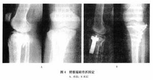 （圖）脛骨平台骨折