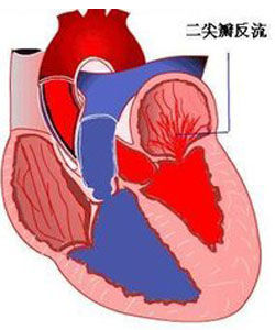 二尖瓣關閉不全
