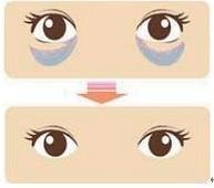 眼袋