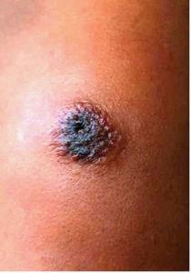 皮膚炭疽疫情 皮膚炭疽疫情