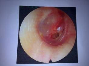 耳膜穿孔 耳膜穿孔