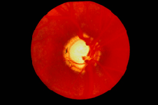 藥物相關性青光眼