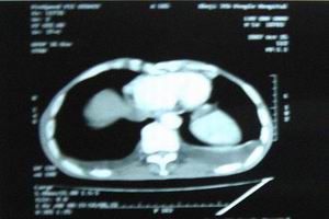 甲狀旁腺功能減退症