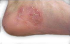 維生素B1缺乏病