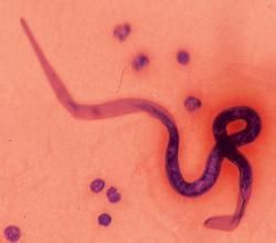 盤尾絲蟲病 盤尾絲蟲病